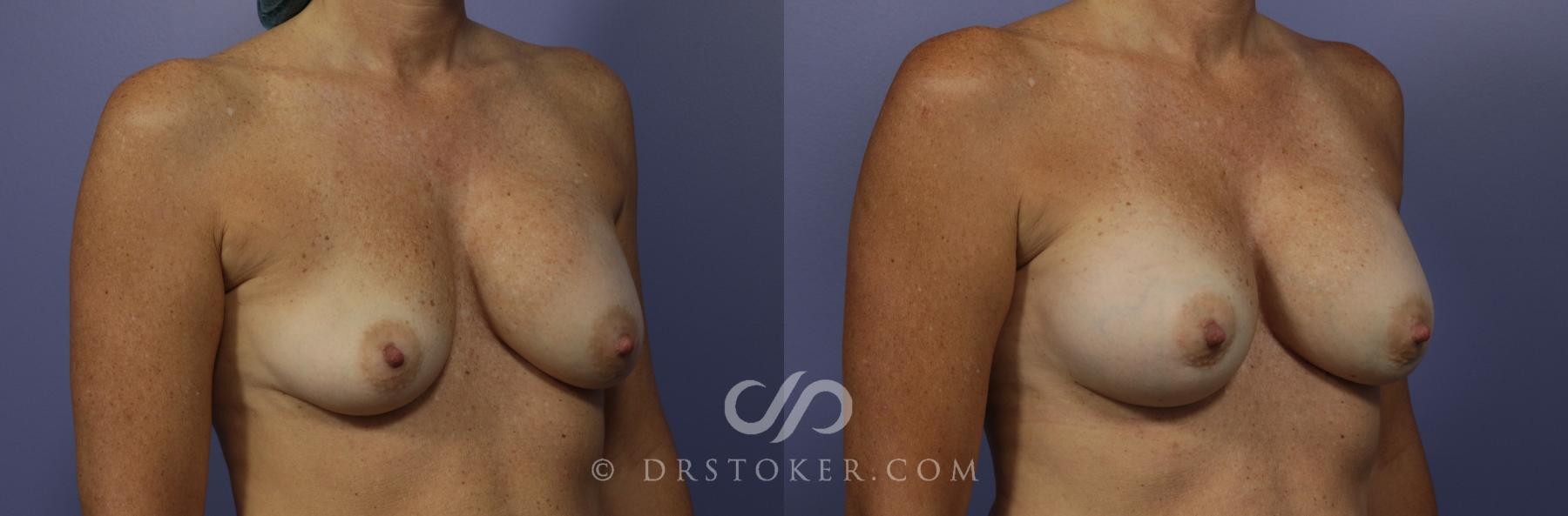 Before & After Breast Augmentation, Rapid Recovery Case 1029 View #4 View in Los Angeles, CA