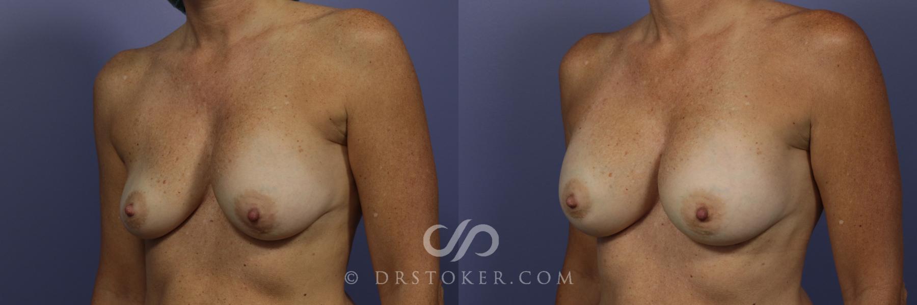 Before & After Breast Augmentation, Rapid Recovery Case 1029 View #5 View in Los Angeles, CA
