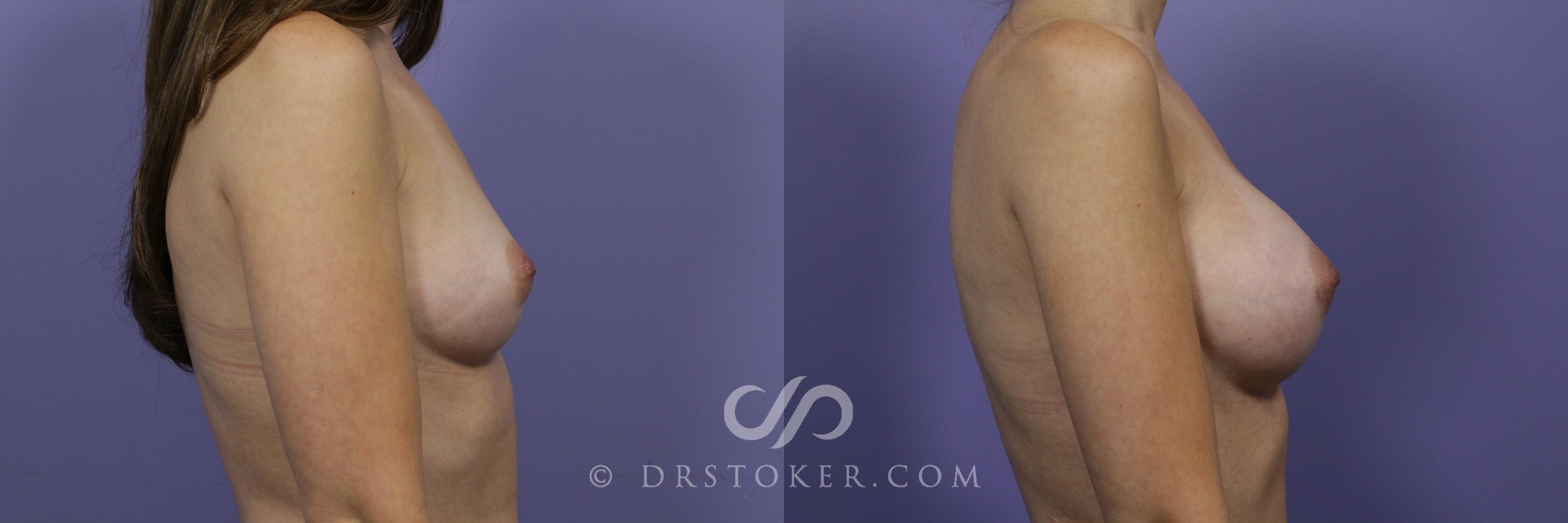 Before & After Breast Augmentation, Rapid Recovery Case 1030 View #3 View in Los Angeles, CA