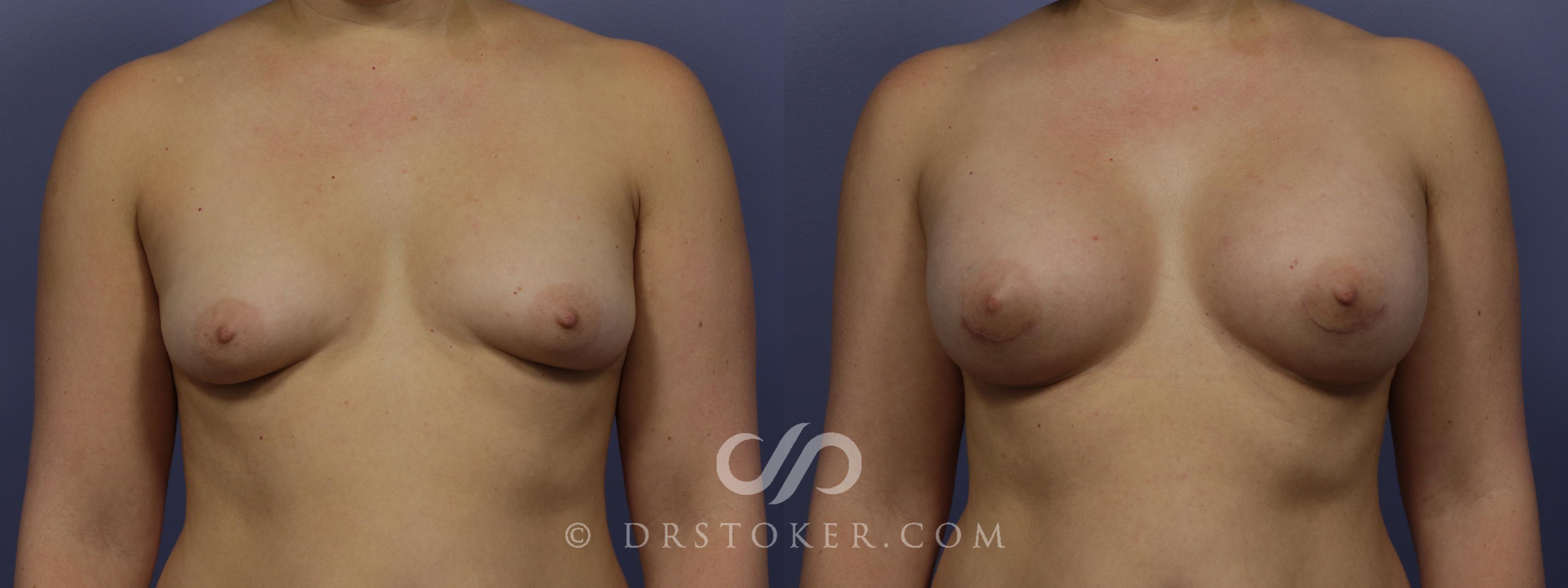 Before & After Breast Augmentation, Rapid Recovery Case 1031 View #1 View in Los Angeles, CA