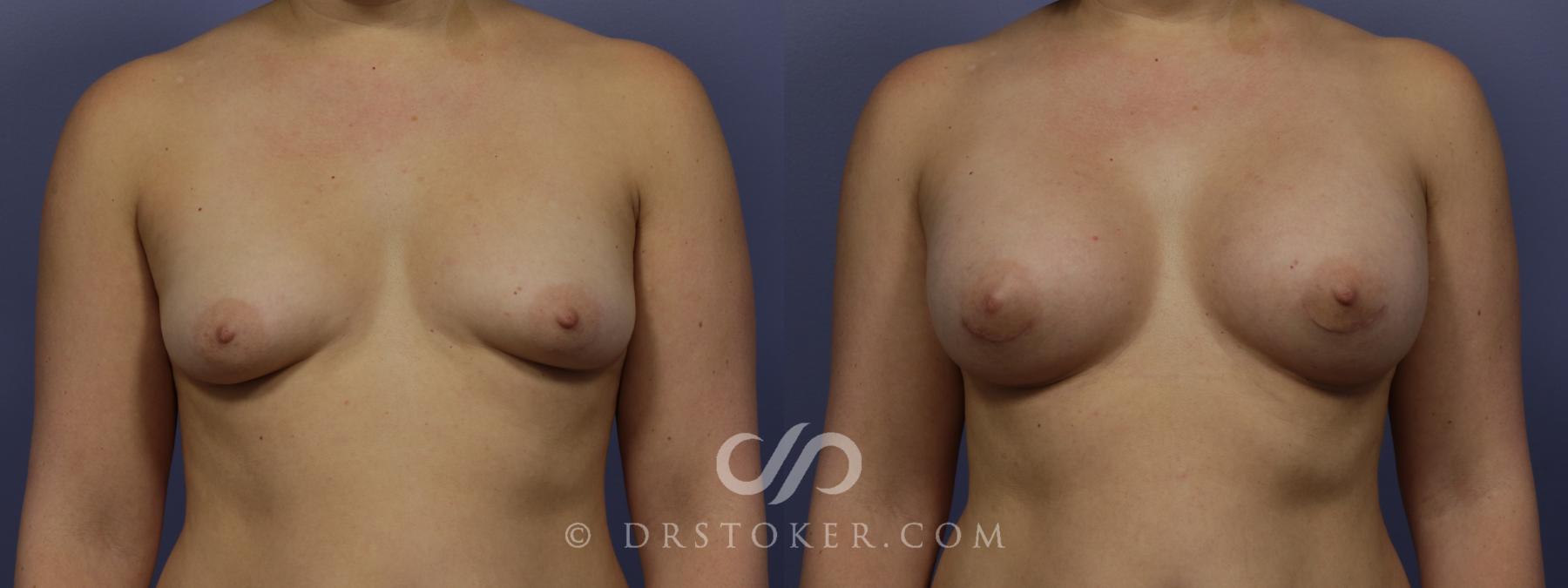 Before & After Breast Augmentation, Rapid Recovery Case 1031 View #1 View in Los Angeles, CA