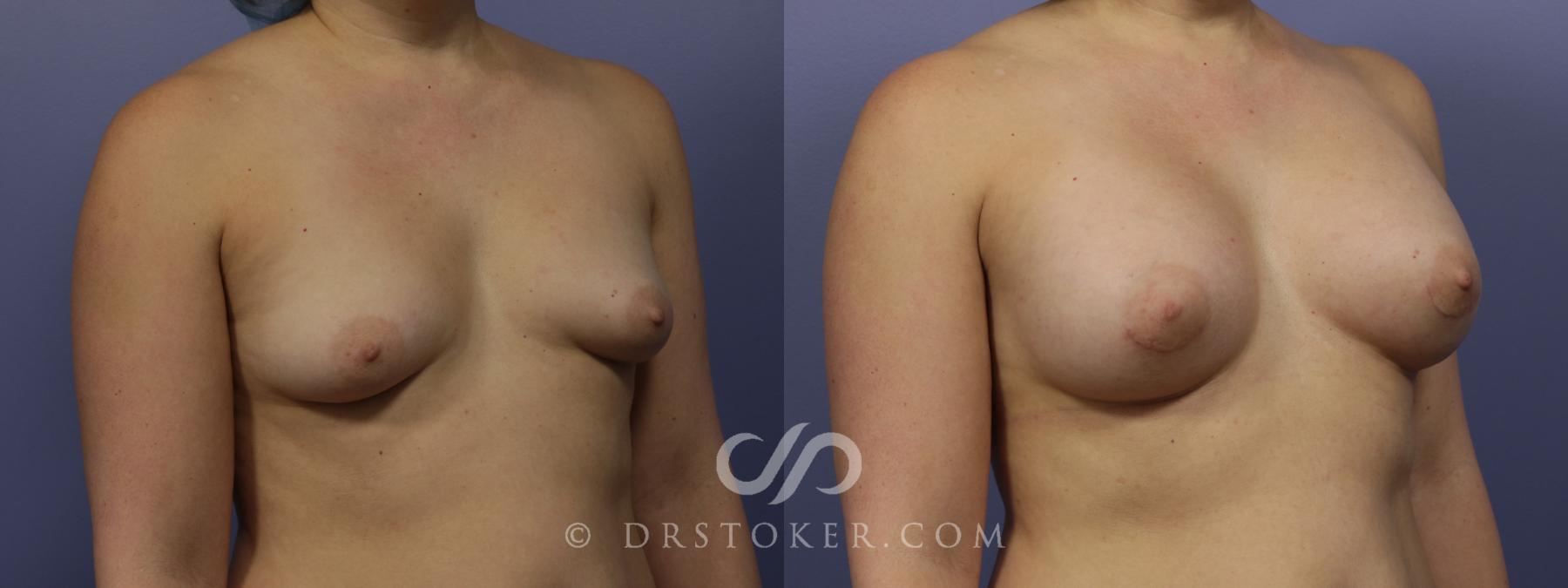 Before & After Breast Augmentation, Rapid Recovery Case 1031 View #2 View in Los Angeles, CA