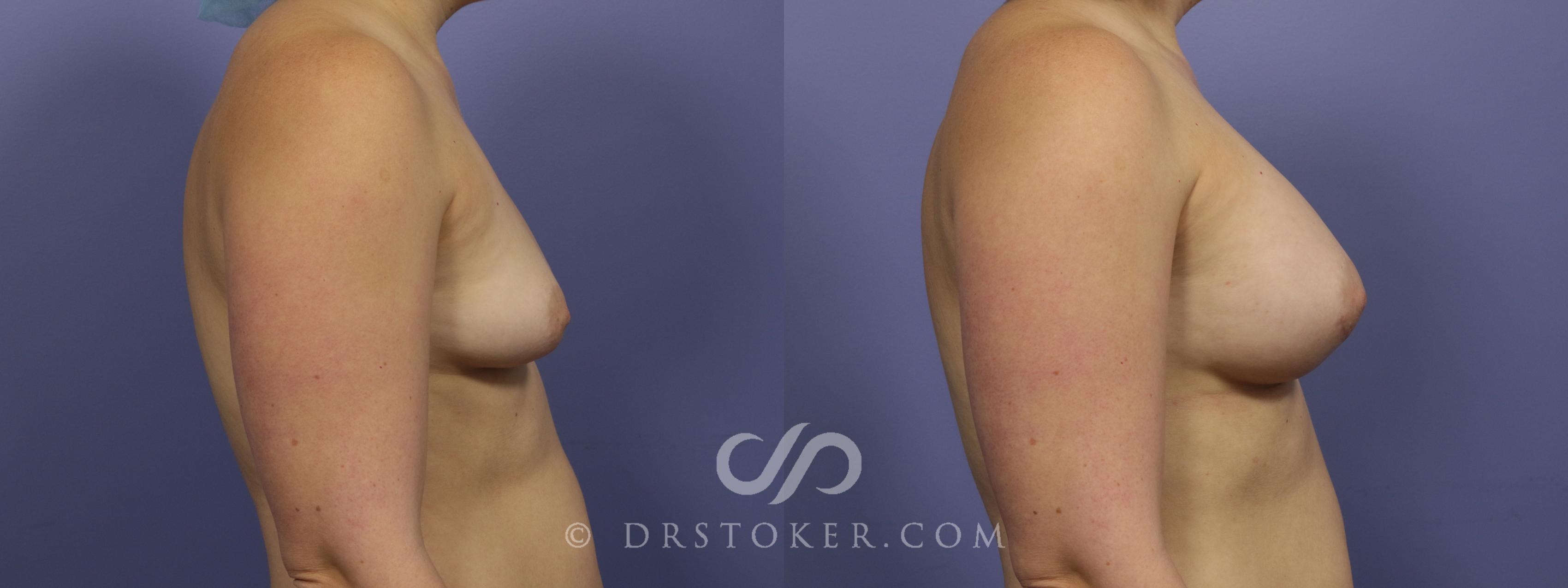 Before & After Breast Augmentation, Rapid Recovery Case 1031 View #3 View in Los Angeles, CA