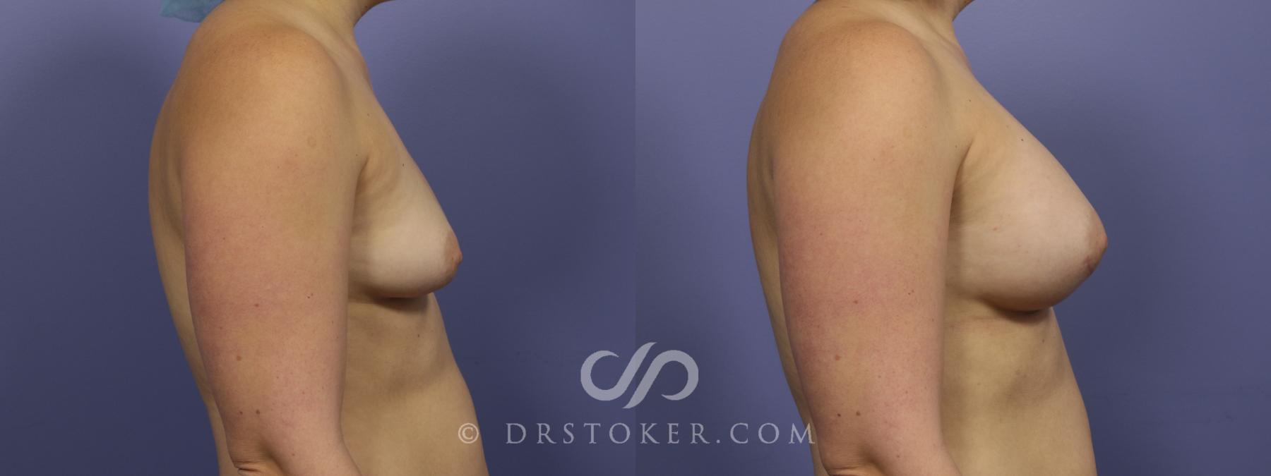 Before & After Breast Augmentation, Rapid Recovery Case 1031 View #3 View in Los Angeles, CA