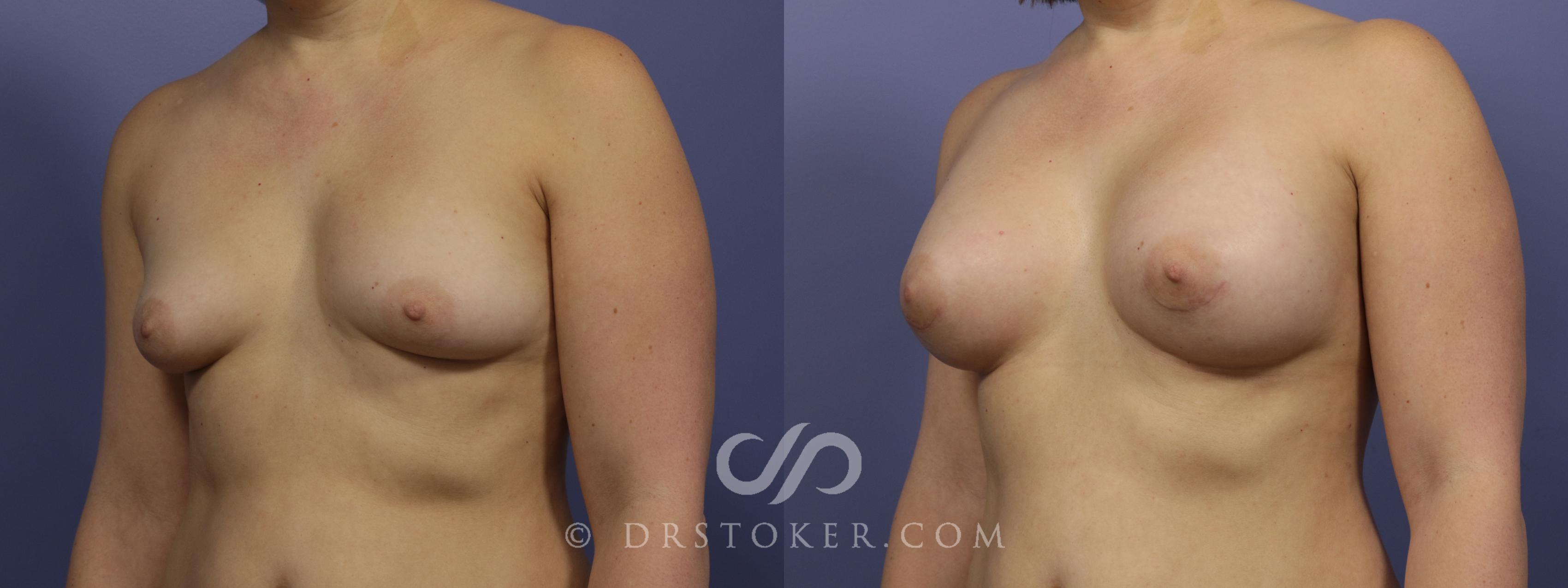 Before & After Breast Augmentation, Rapid Recovery Case 1031 View #4 View in Los Angeles, CA