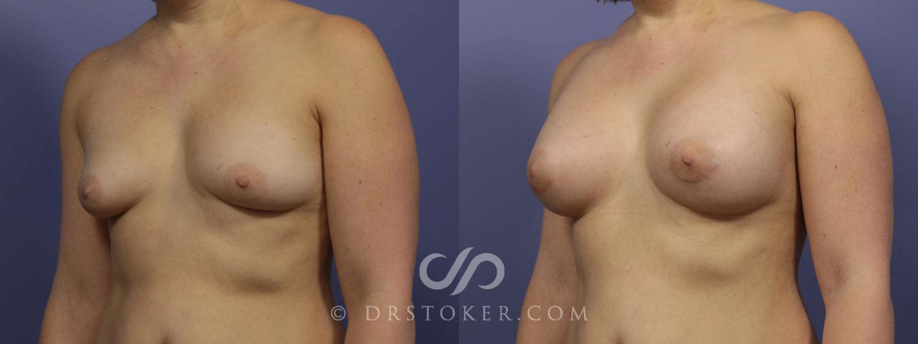 Before & After Breast Augmentation, Rapid Recovery Case 1031 View #4 View in Los Angeles, CA