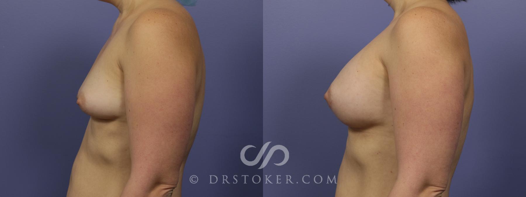 Before & After Breast Augmentation, Rapid Recovery Case 1031 View #5 View in Los Angeles, CA