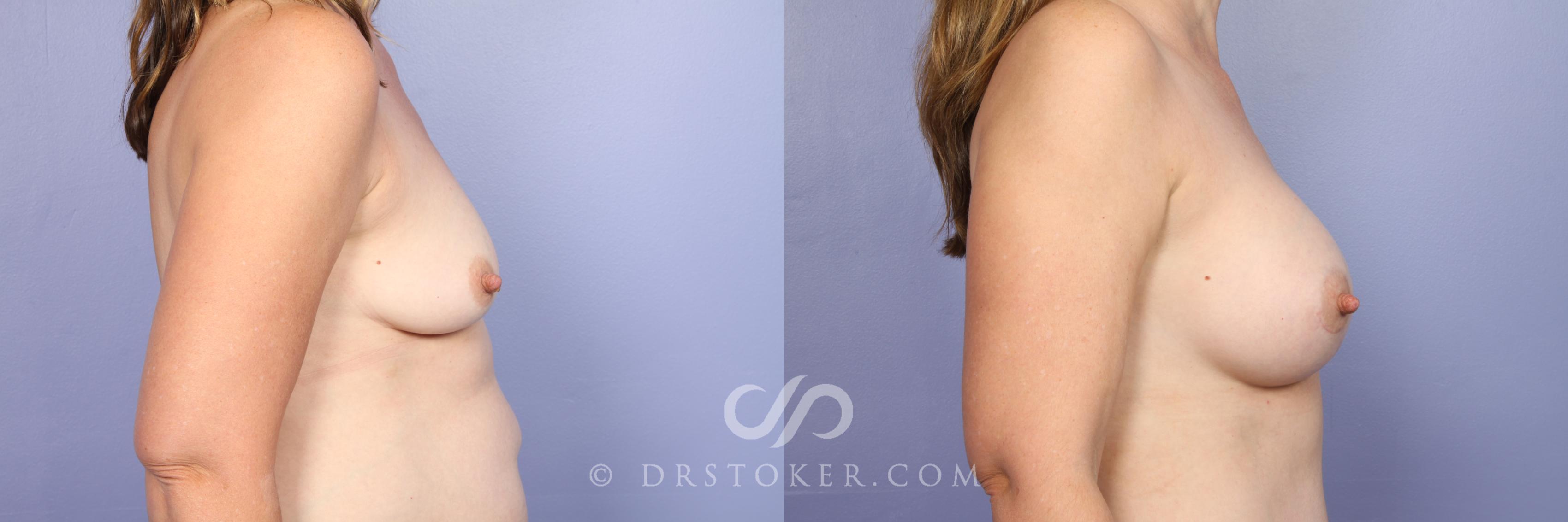 Before & After Breast Augmentation, Rapid Recovery Case 1032 View #3 View in Los Angeles, CA