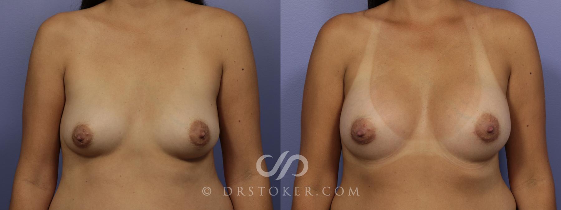 Before & After Breast Augmentation, Rapid Recovery Case 1033 View #1 View in Los Angeles, CA