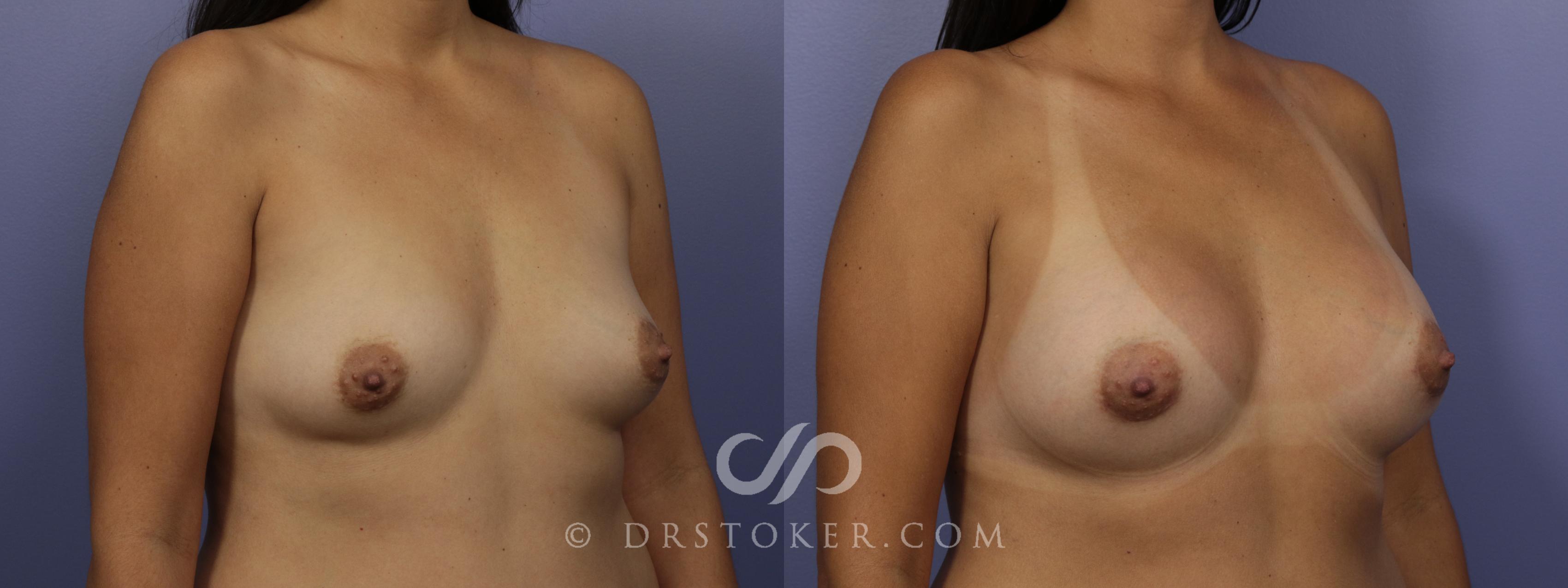 Before & After Breast Augmentation, Rapid Recovery Case 1033 View #2 View in Los Angeles, CA