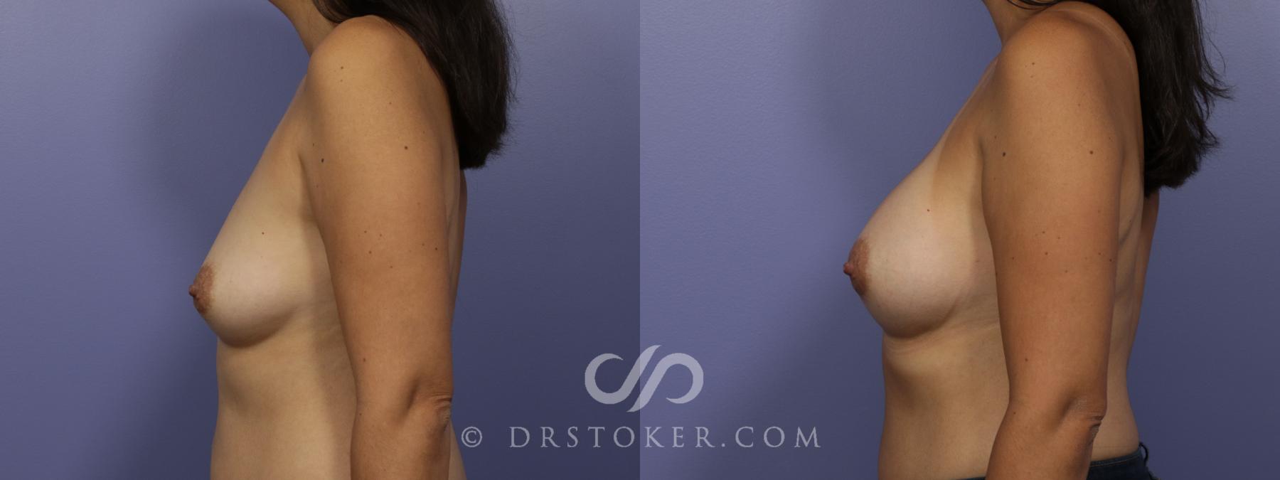 Before & After Breast Augmentation, Rapid Recovery Case 1033 View #4 View in Los Angeles, CA