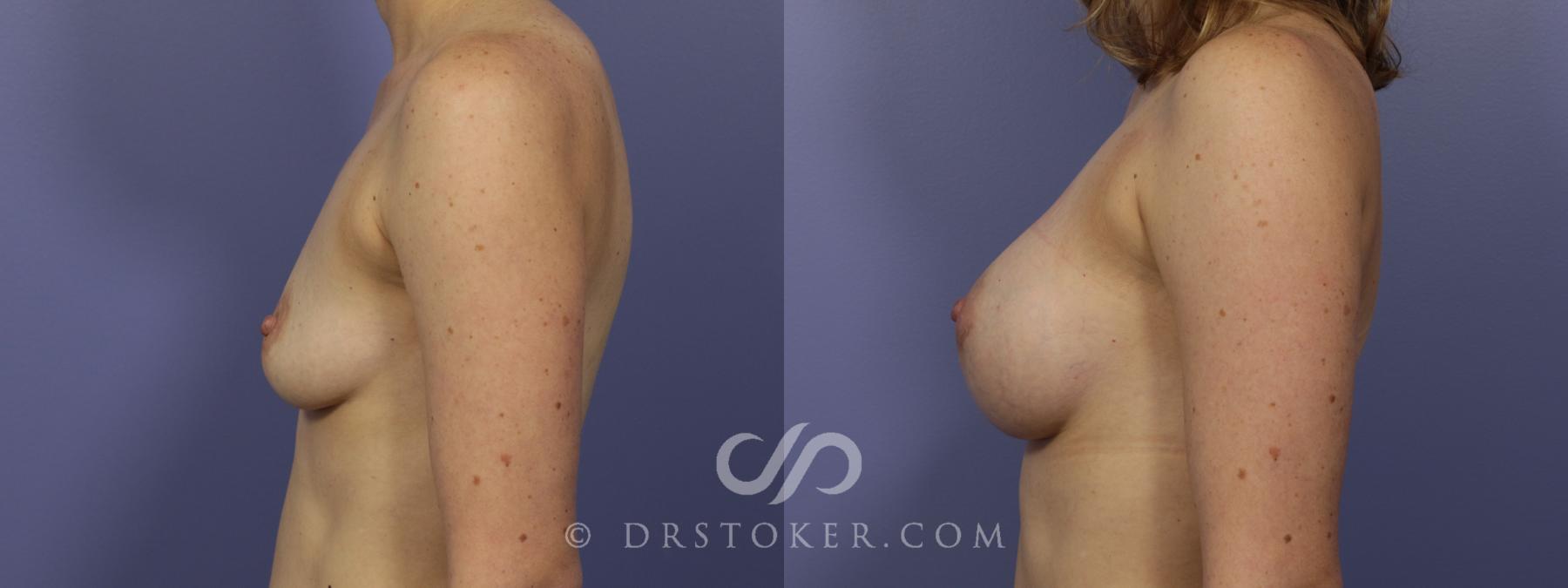 Before & After Breast Augmentation, Rapid Recovery Case 1034 View #3 View in Los Angeles, CA