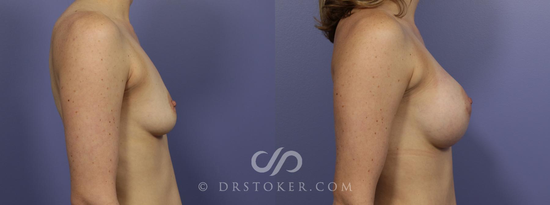 Before & After Breast Augmentation, Rapid Recovery Case 1034 View #4 View in Los Angeles, CA