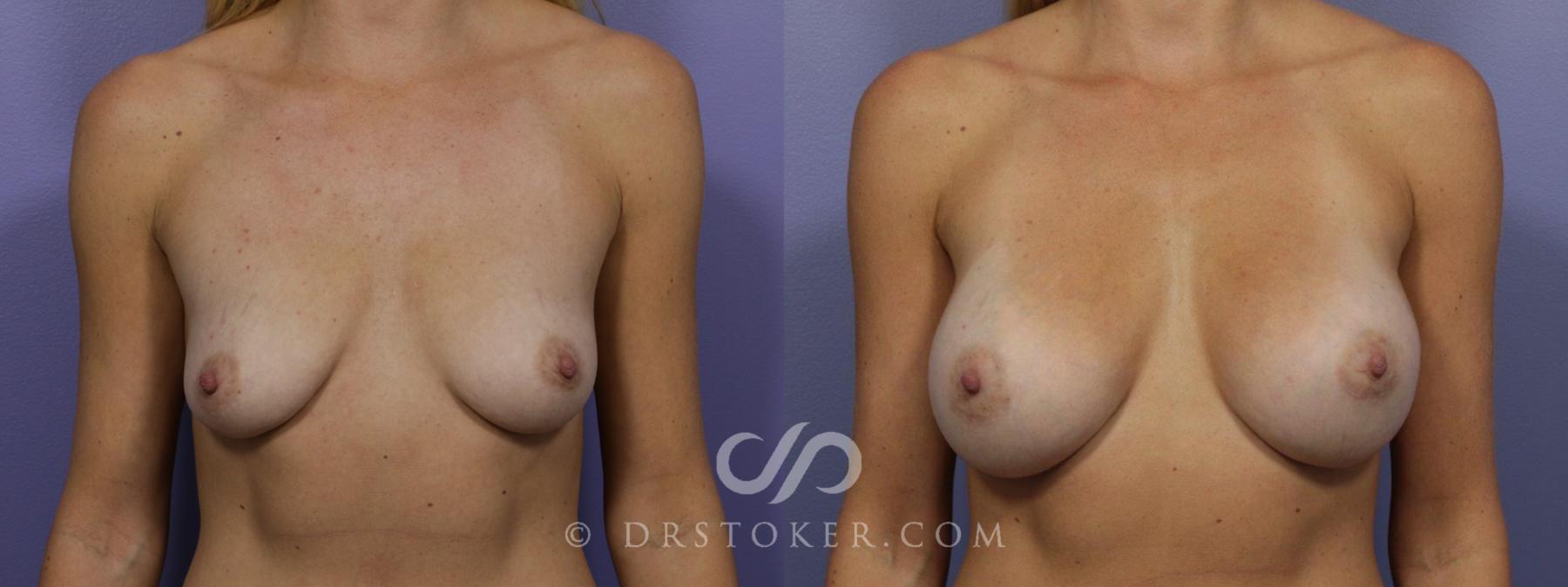 Before & After Breast Augmentation, Rapid Recovery Case 1036 View #1 View in Los Angeles, CA