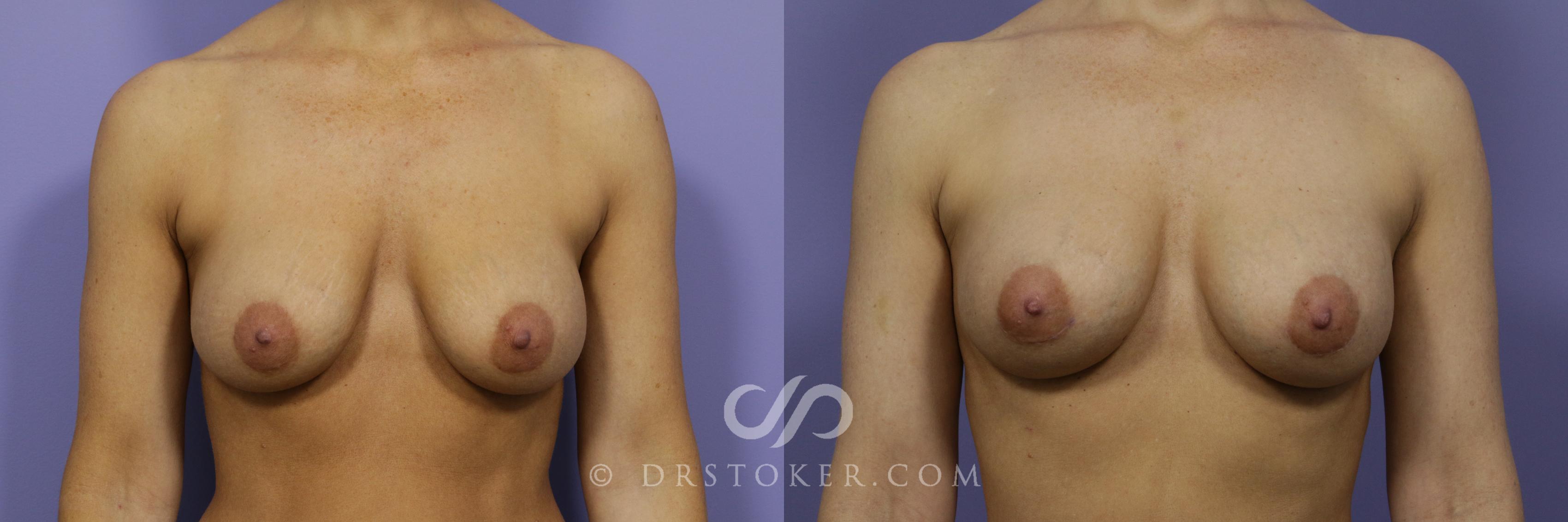 Before & After Breast Augmentation, Rapid Recovery Case 1037 View #1 View in Los Angeles, CA