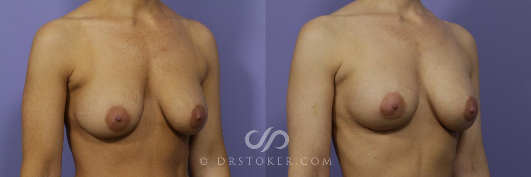 Before & After Breast Augmentation, Rapid Recovery Case 1037 View #2 View in Los Angeles, CA