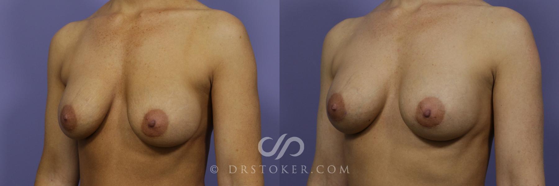 Before & After Breast Augmentation, Rapid Recovery Case 1037 View #4 View in Los Angeles, CA