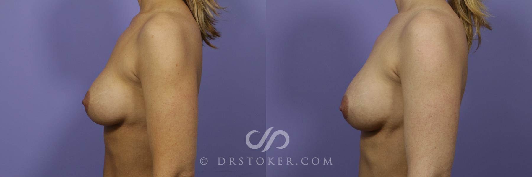 Before & After Breast Augmentation, Rapid Recovery Case 1037 View #5 View in Los Angeles, CA
