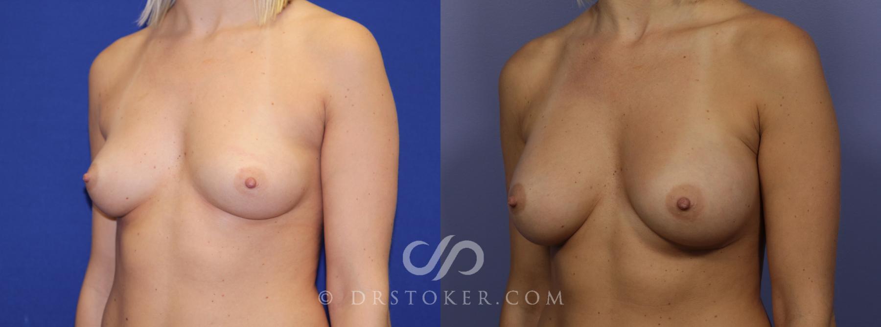 Before & After Breast Augmentation, Rapid Recovery Case 1040 View #2 View in Los Angeles, CA