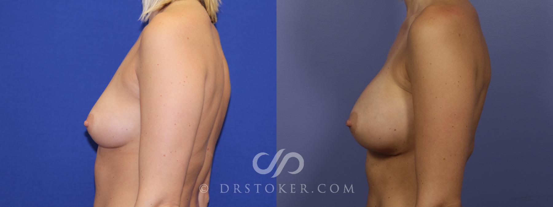 Before & After Breast Augmentation, Rapid Recovery Case 1040 View #3 View in Los Angeles, CA