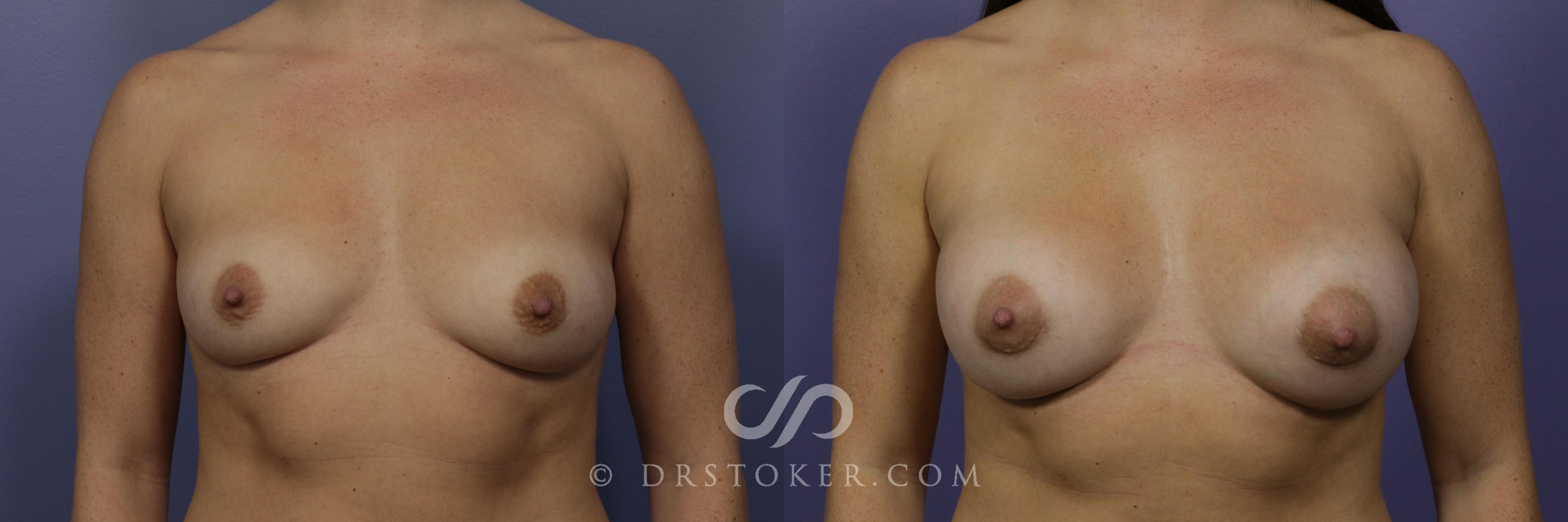 Before & After Breast Augmentation, Rapid Recovery Case 1041 View #1 View in Los Angeles, CA