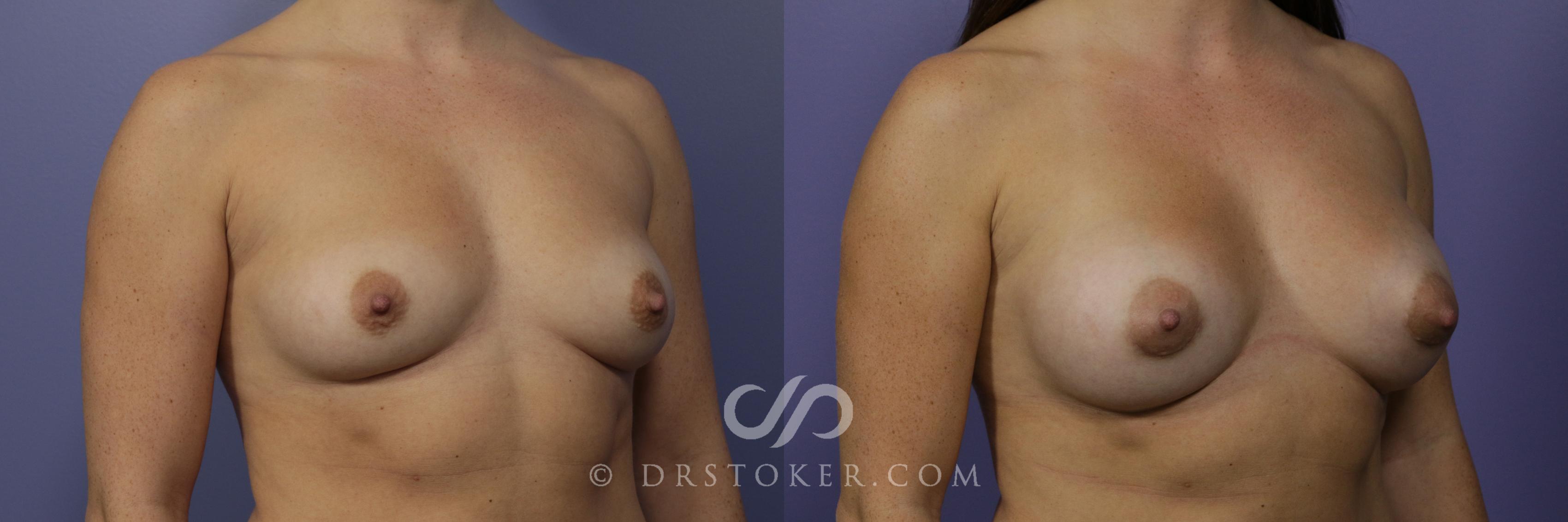 Before & After Breast Augmentation, Rapid Recovery Case 1041 View #2 View in Los Angeles, CA