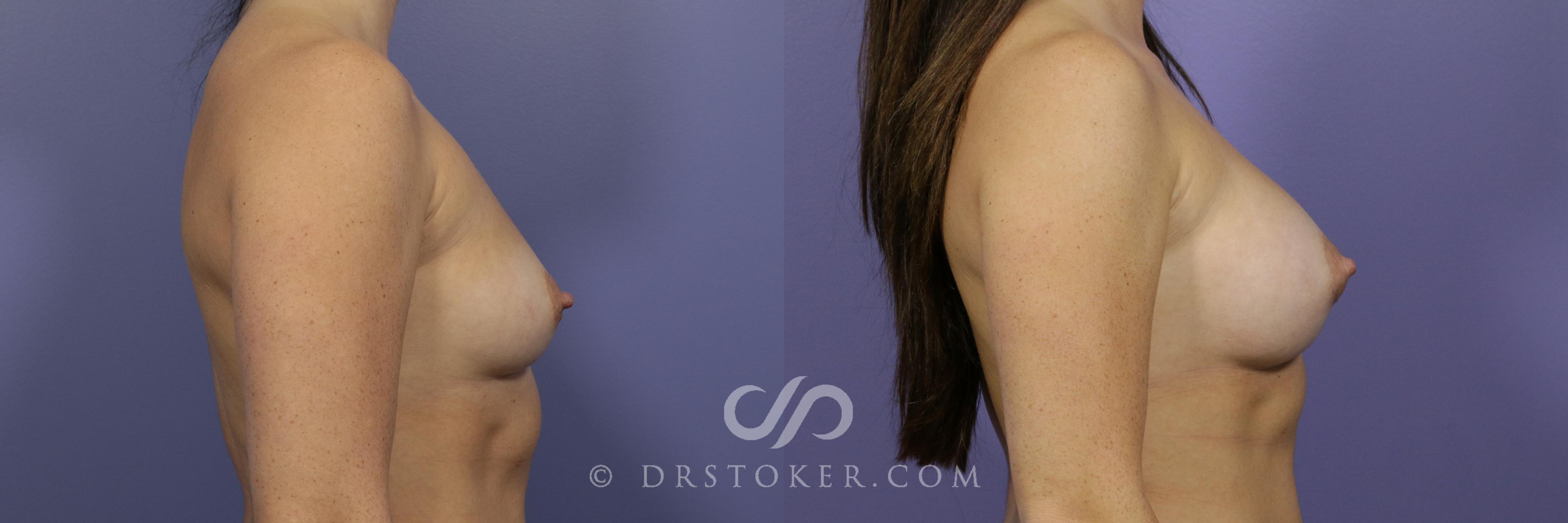 Before & After Breast Augmentation, Rapid Recovery Case 1041 View #3 View in Los Angeles, CA