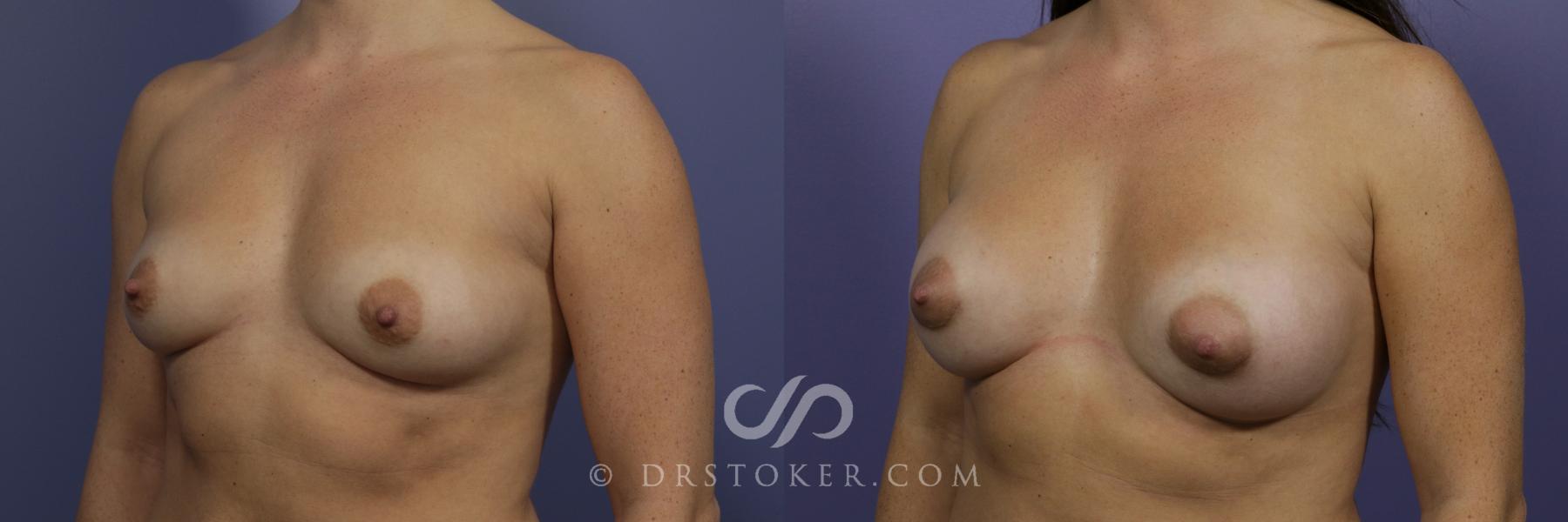 Before & After Breast Augmentation, Rapid Recovery Case 1041 View #4 View in Los Angeles, CA