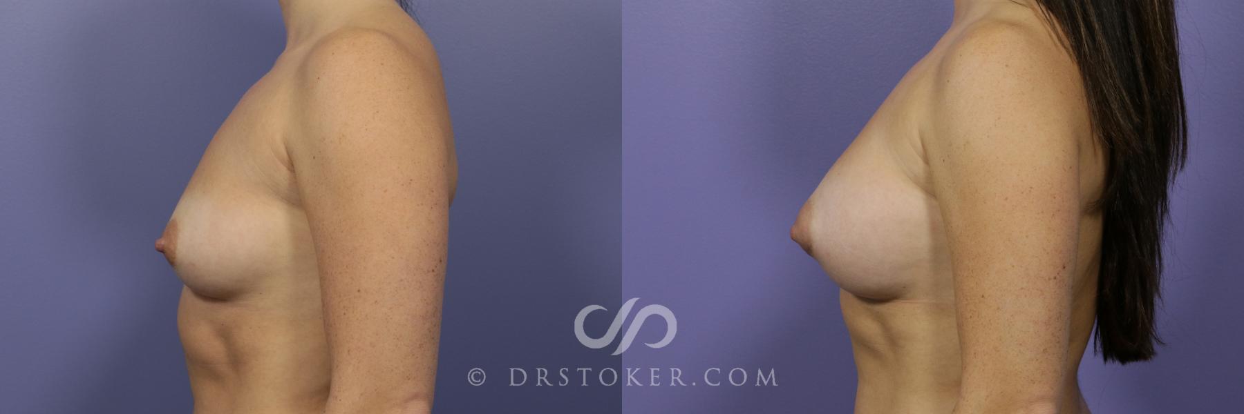 Before & After Breast Augmentation, Rapid Recovery Case 1041 View #5 View in Los Angeles, CA