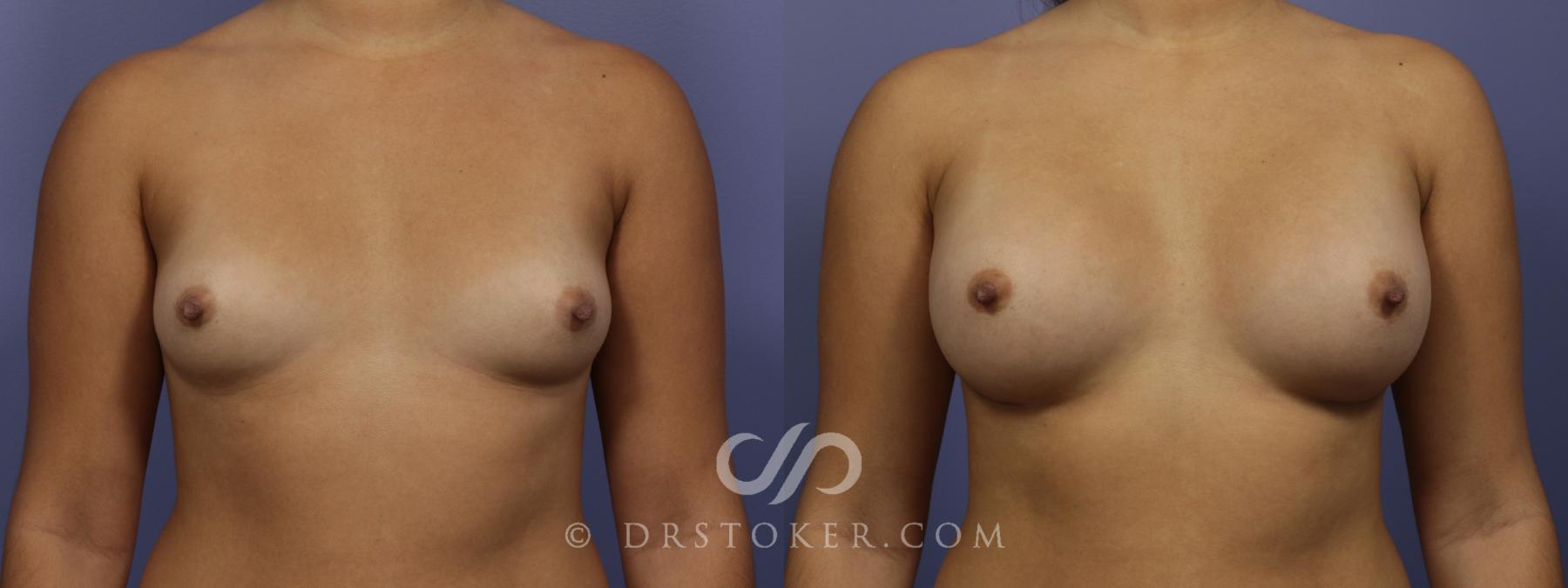 Before & After Breast Augmentation, Rapid Recovery Case 1042 View #1 View in Los Angeles, CA