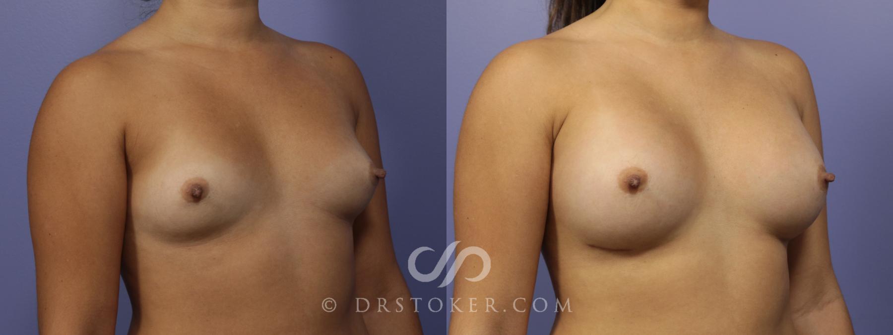 Before & After Breast Augmentation, Rapid Recovery Case 1042 View #2 View in Los Angeles, CA