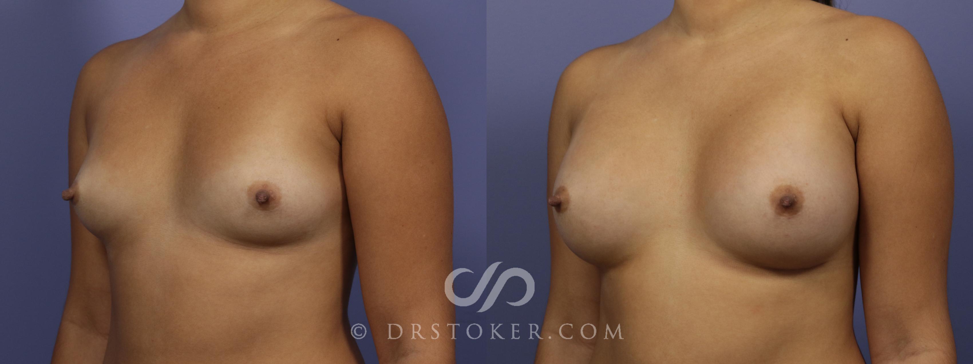 Before & After Breast Augmentation, Rapid Recovery Case 1042 View #4 View in Los Angeles, CA