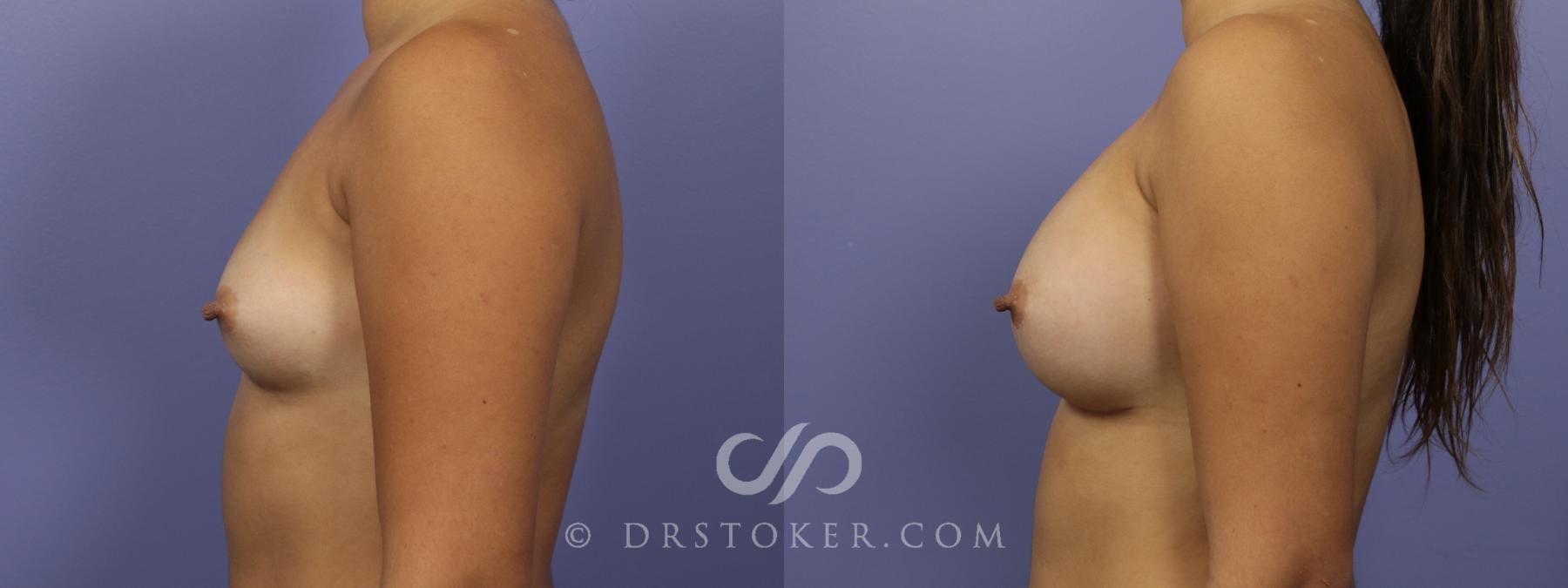 Before & After Breast Augmentation, Rapid Recovery Case 1042 View #5 View in Los Angeles, CA