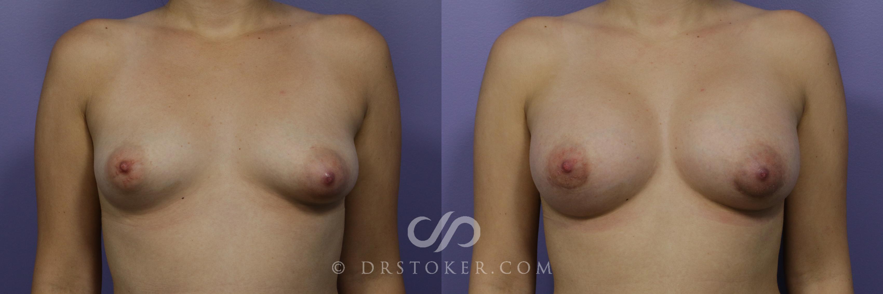 Before & After Breast Augmentation, Rapid Recovery Case 1049 View #1 View in Los Angeles, CA