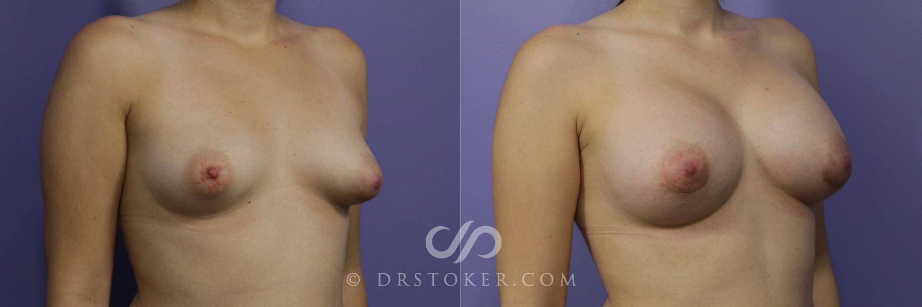 Before & After Breast Augmentation, Rapid Recovery Case 1049 View #2 View in Los Angeles, CA