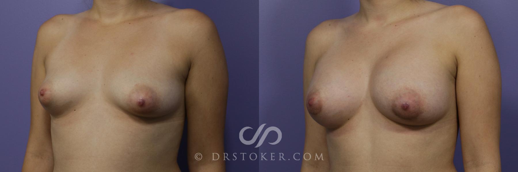Before & After Breast Augmentation, Rapid Recovery Case 1049 View #3 View in Los Angeles, CA
