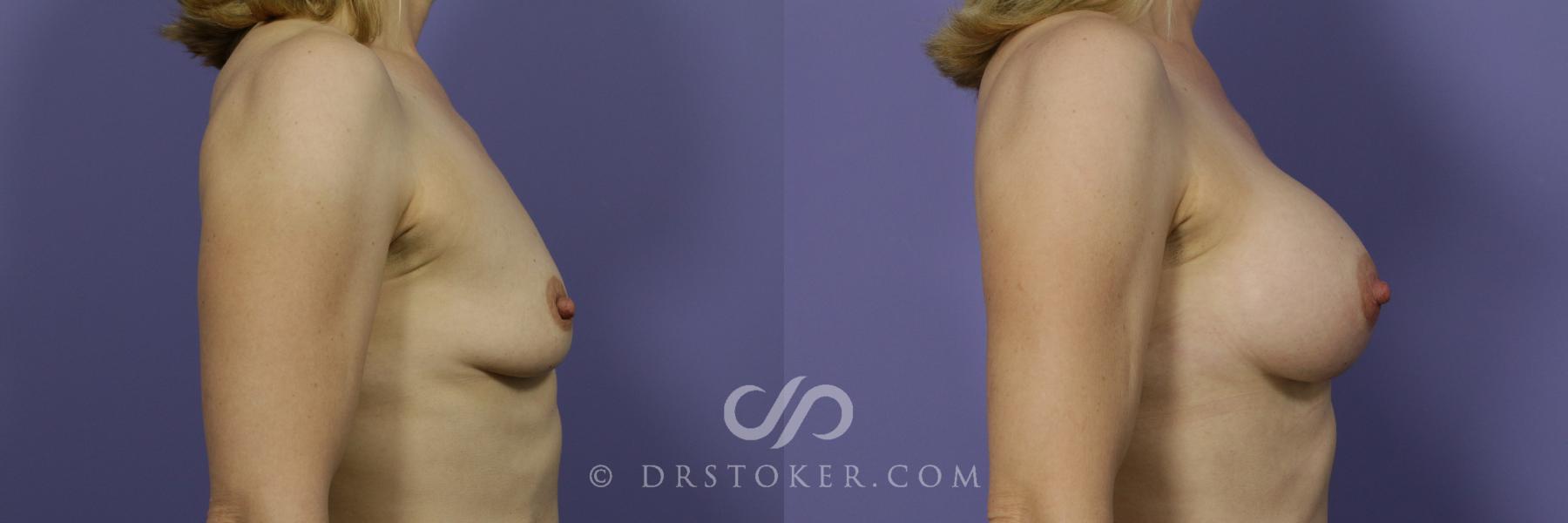 Before & After Breast Augmentation, Rapid Recovery Case 1050 View #3 View in Los Angeles, CA