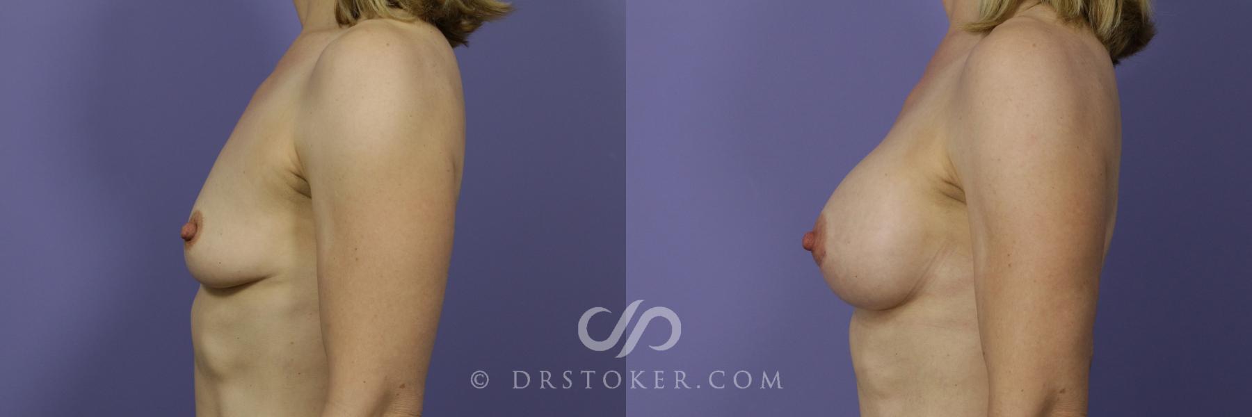 Before & After Breast Augmentation, Rapid Recovery Case 1050 View #5 View in Los Angeles, CA