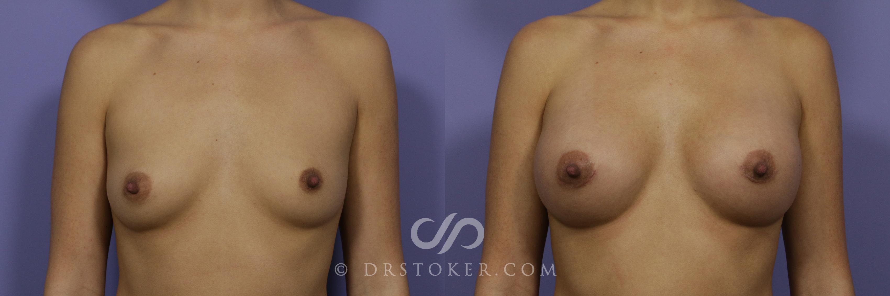Before & After Rapid Recovery Breast Augmentation Case 1052 View #1 View in Los Angeles, CA