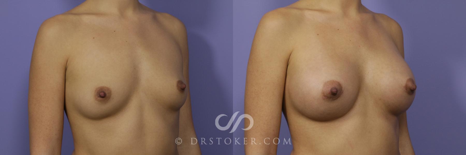 Before & After Breast Augmentation, Rapid Recovery Case 1052 View #2 View in Los Angeles, CA