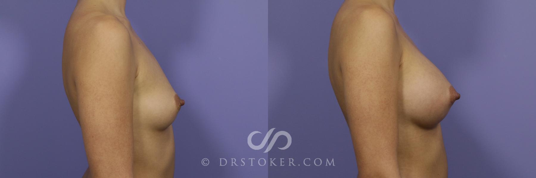 Before & After Breast Augmentation, Rapid Recovery Case 1052 View #3 View in Los Angeles, CA