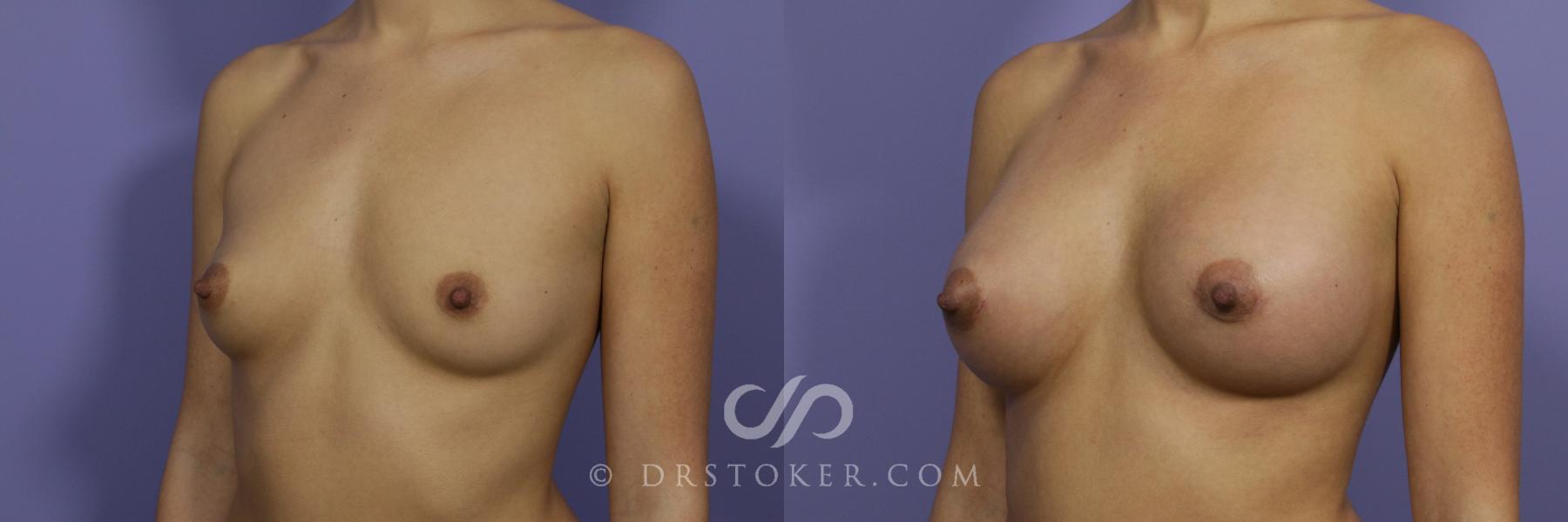 Before & After Breast Augmentation, Rapid Recovery Case 1052 View #4 View in Los Angeles, CA