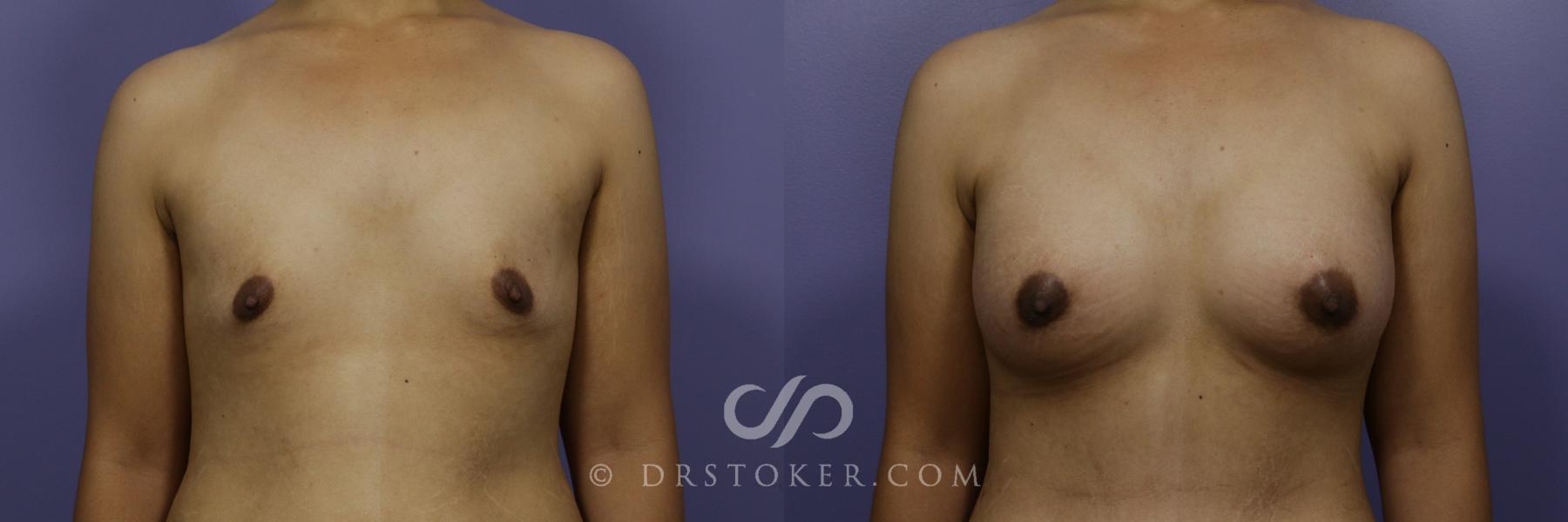 Before & After Breast Augmentation, Rapid Recovery Case 1053 View #1 View in Los Angeles, CA