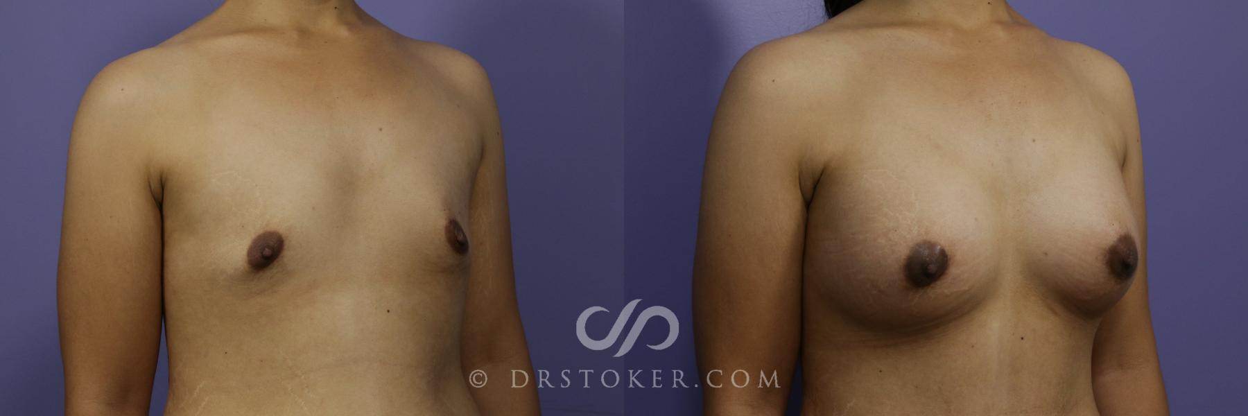 Before & After Breast Augmentation, Rapid Recovery Case 1053 View #2 View in Los Angeles, CA
