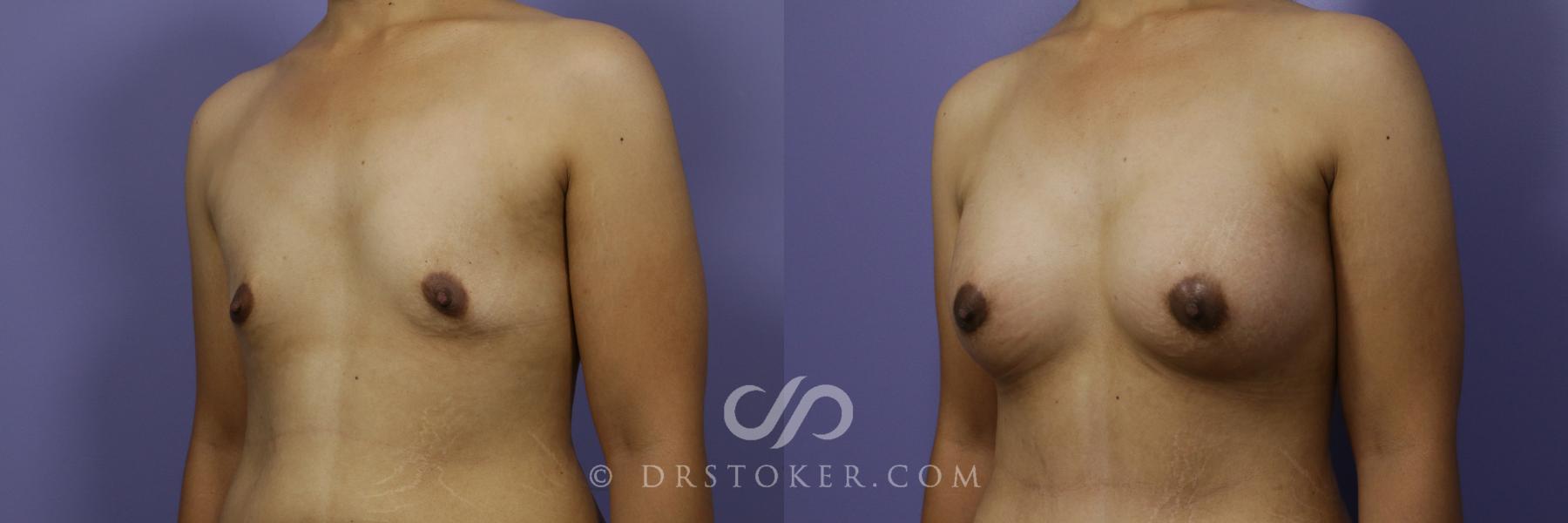 Before & After Breast Augmentation, Rapid Recovery Case 1053 View #3 View in Los Angeles, CA