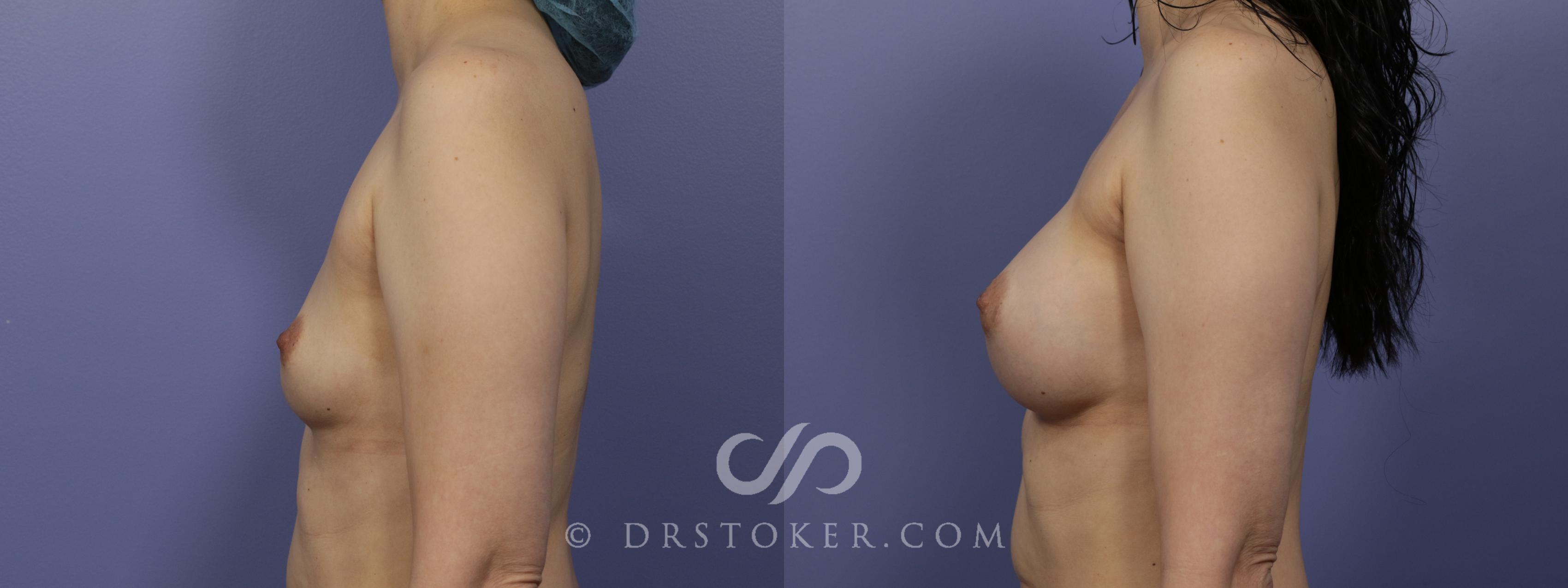 Before & After Breast Augmentation, Rapid Recovery Case 1056 View #4 View in Los Angeles, CA