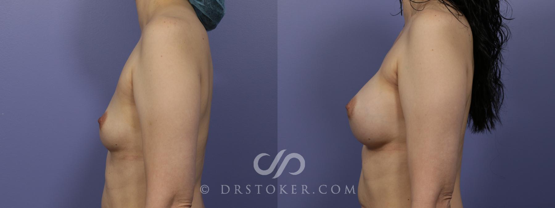 Before & After Breast Augmentation, Rapid Recovery Case 1056 View #4 View in Los Angeles, CA