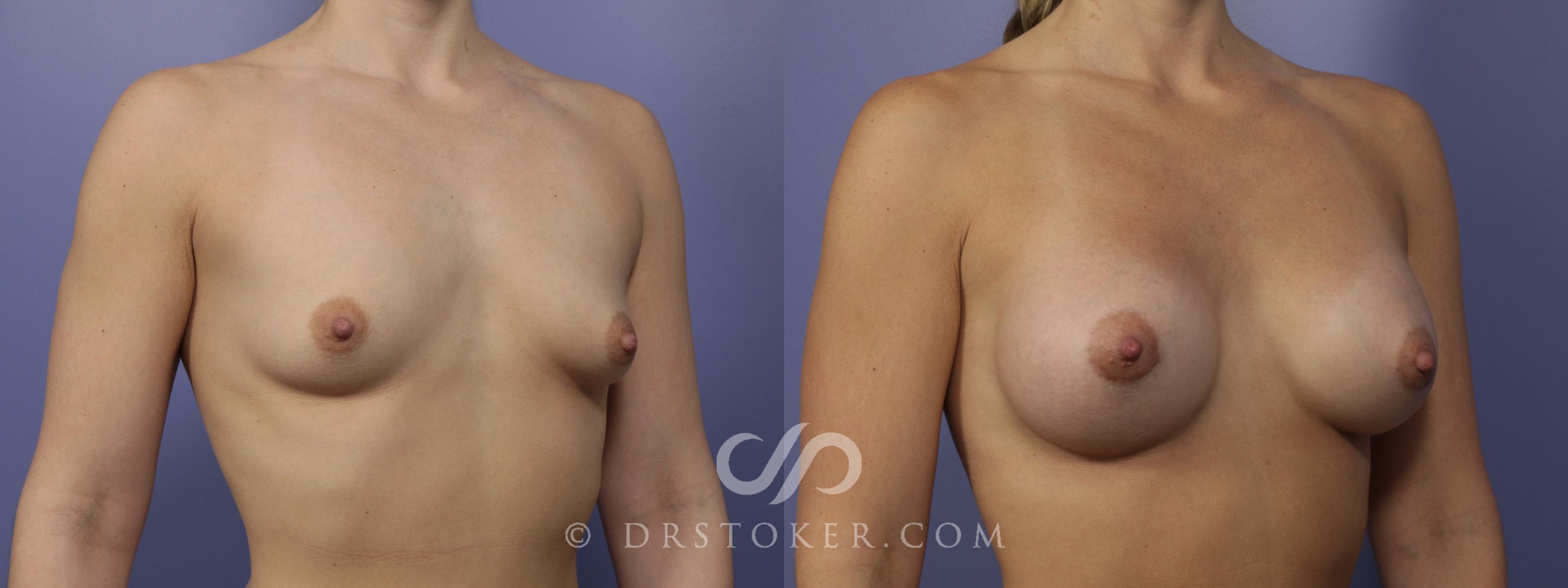 Before & After Breast Augmentation, Rapid Recovery Case 1057 View #2 View in Los Angeles, CA