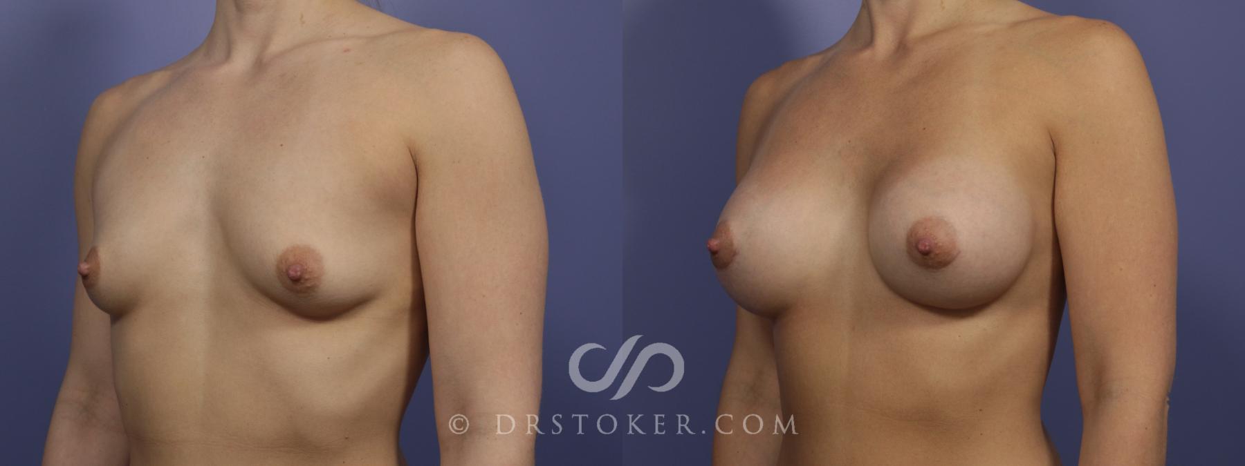 Before & After Breast Augmentation, Rapid Recovery Case 1057 View #4 View in Los Angeles, CA