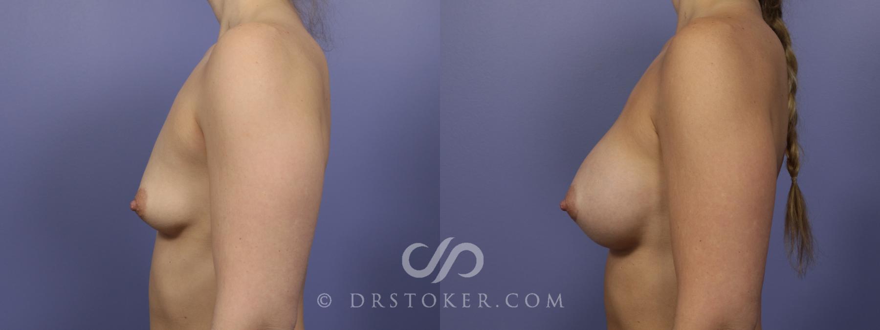 Before & After Breast Augmentation, Rapid Recovery Case 1057 View #5 View in Los Angeles, CA